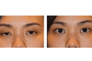 Oculoplasty Surgery in Delhi