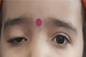 Oculoplasty Surgery in Delhi