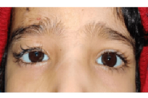 Oculoplasty Surgery in Delhi