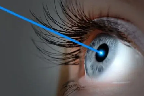 LASIK Eye Surgery