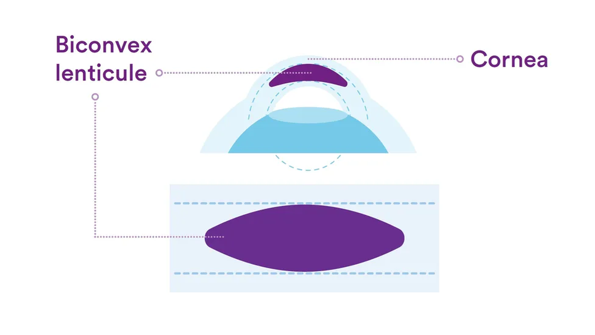 Biconvex lenticule and cornea illustration